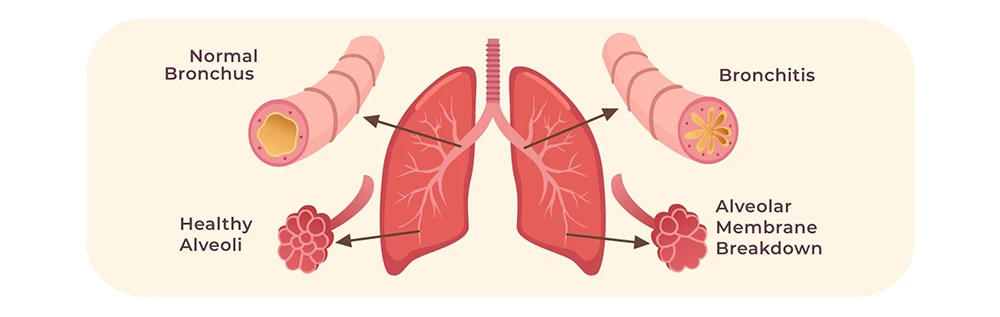 chronic obstructive pulmonary disease