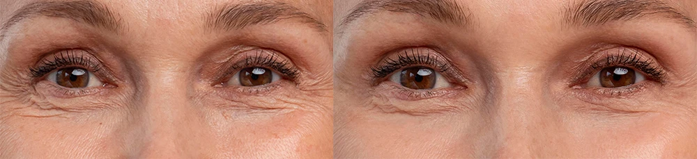 eyes with Puffiness and eye bags with red light therapy before and after