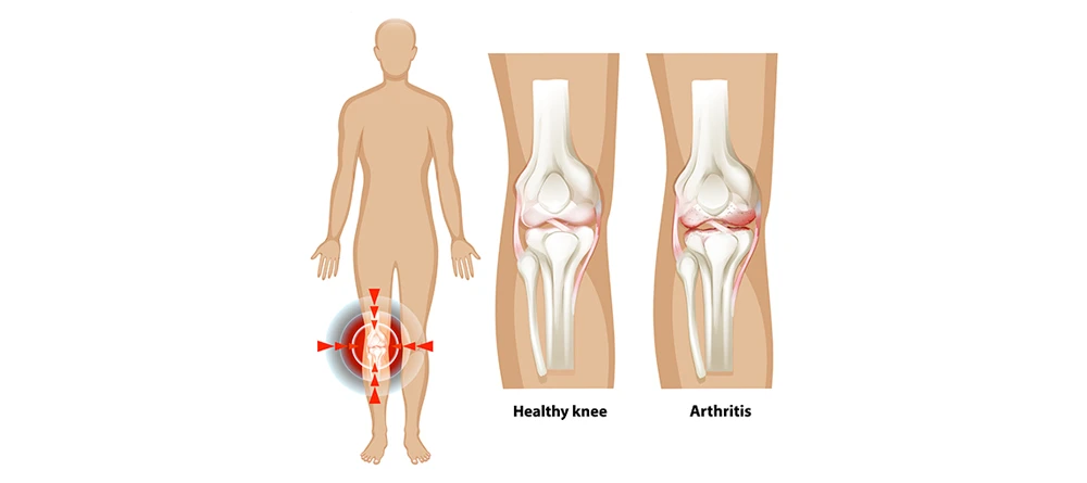 knee pain and arthritis