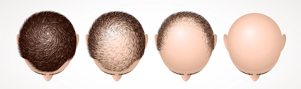 process of serious hair loss